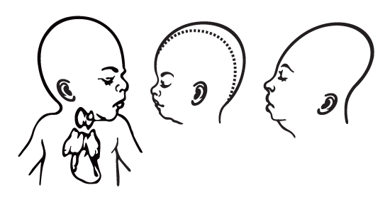 birth-defect-diagram
